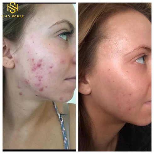 Lotion chấm mụn chứa 5% Benzoyl Peroxide Obagi CLENZIderm MD Therapeutic