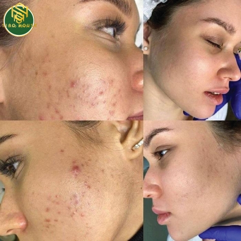 Tinh chất giảm mụn & kiểm soát nhờn MARTI DERM Acniover Serum 30mL 