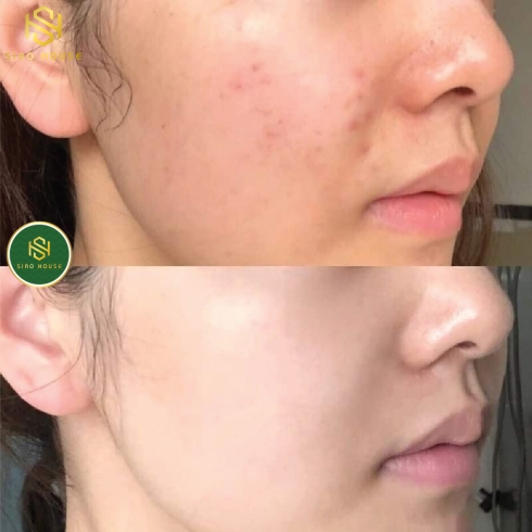 Kem dưỡng ẩm BABE Stop Akin Hidratante Matificante 50mL