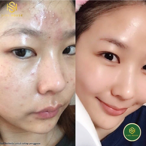 Kem dưỡng ẩm BABE Stop Akin Hidratante Matificante 50mL