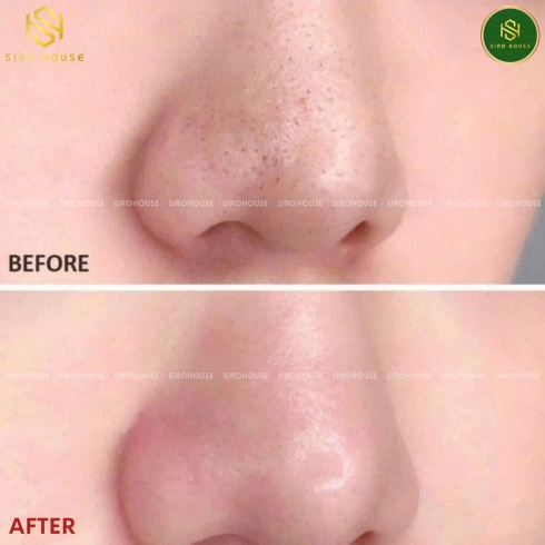 Tinh chất tẩy tế bào chết CNP Laboratory Invisible Peelling Booster Essence 100mL